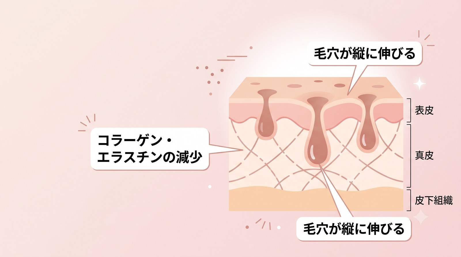 コラーゲン減少で毛穴が縦長に伸びる、たるみ毛穴のイメージ図