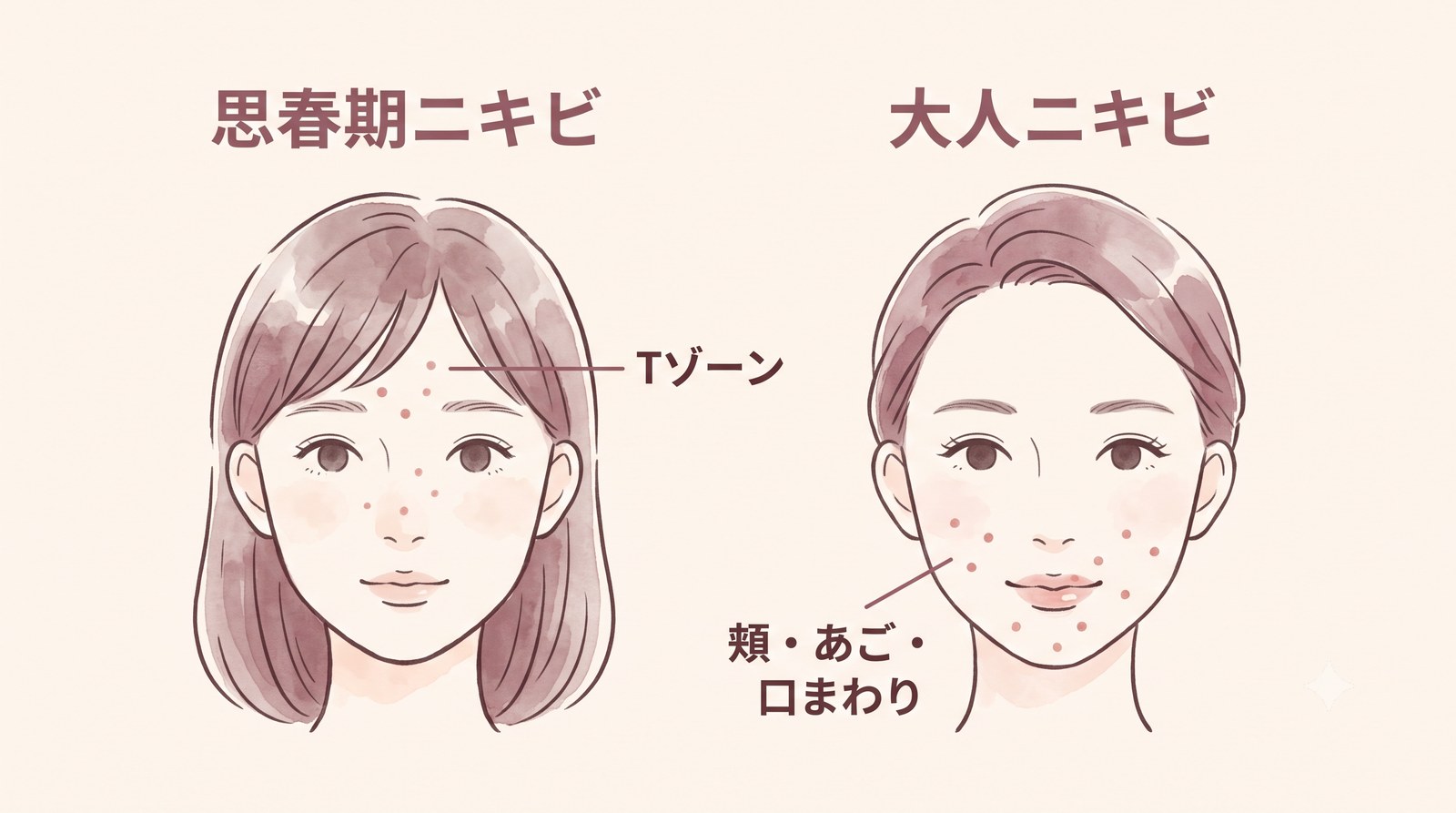 思春期ニキビと大人ニキビのできやすい部位を比較した図解