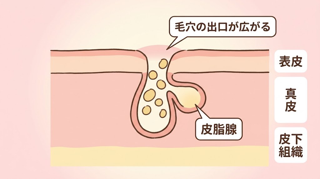 皮脂で毛穴の出口が丸く押し広げられる、開き毛穴の断面イメージ図